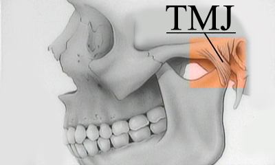 TMJ Bite and Jaw Pain